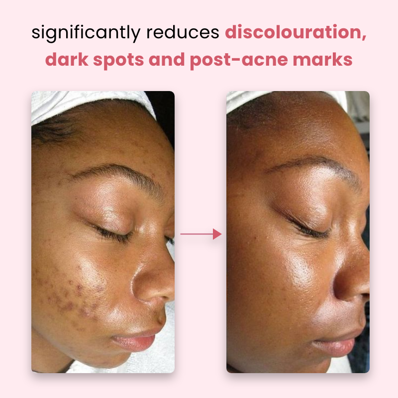 GlowPads™ - Kurkuma- und Kojinsäure-Pads für strahlende Haut!