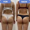 CurveErase™ – Die ultimative Lösung für glatte, cellulitisfreie Haut.