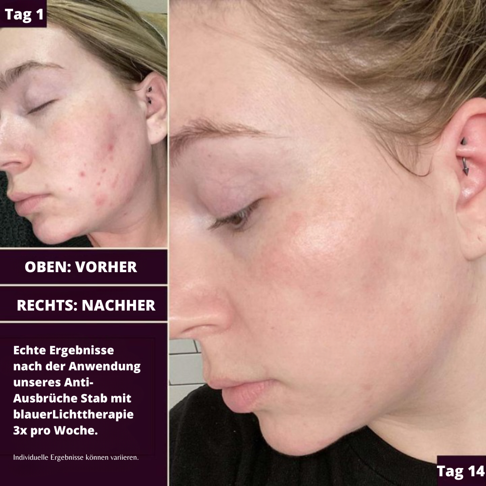 KlareHaut360™ Akne-Busting Lichttherapie Lösung